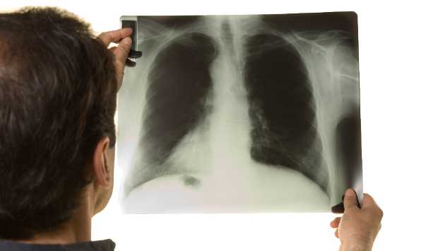 Sergipe já registrou mais de 400 casos de tuberculose em 2017