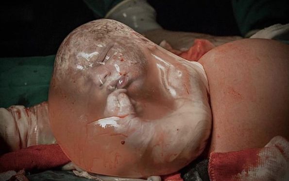 Fotógrafa de BH registra nascimento de bebê empelicado