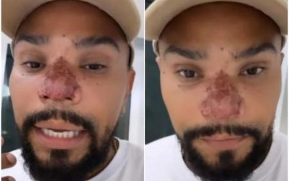 Naldo Benny sofre princípio de necrose no nariz após cirurgia estética