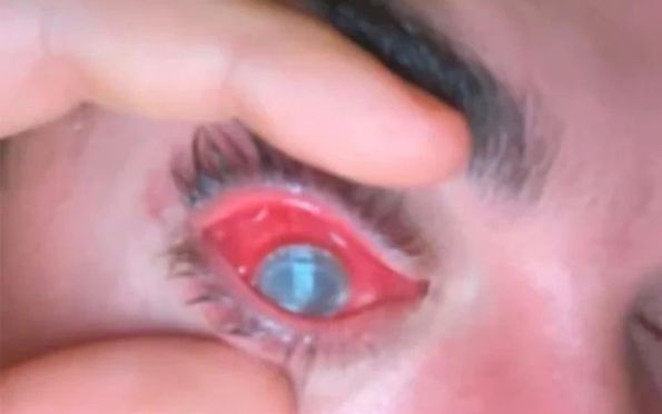 Jovem fica cego de um olho após dormir com lente de contato