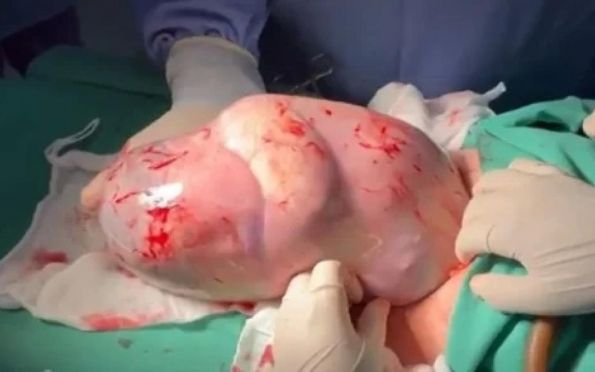 Vídeo: bebê nasce empelicado em GO e médico faz cócegas para acordá-lo