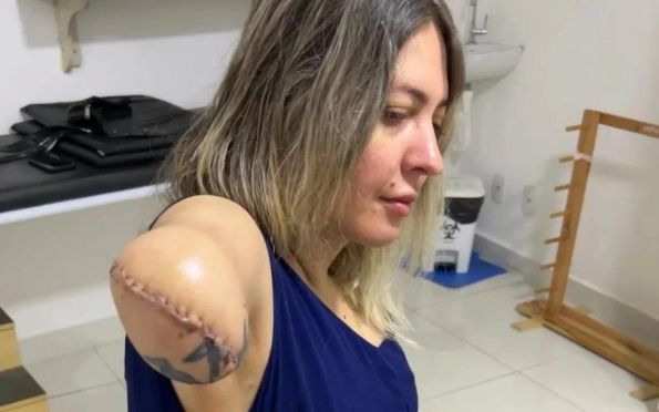 Tatuadora tem braço amputado após fazer lipoescultura em Goiás