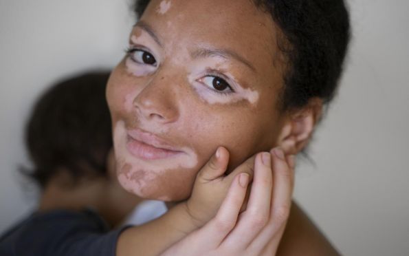 Vitiligo: conheça os sintomas, tratamento e impacto da doença
