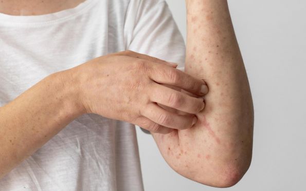 Dermatite atópica: 72% dos pacientes têm saúde emocional comprometida