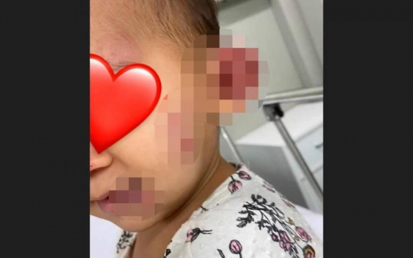 Mãe diz que bebê de 1 ano foi agredida em creche e ficou com hematomas